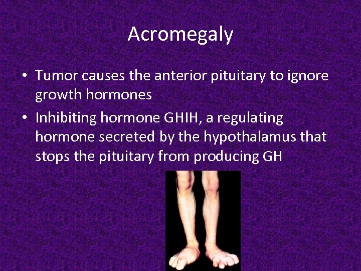 Acromegaly • Tumor causes the anterior pituitary to ignore growth hormones • Inhibiting hormone