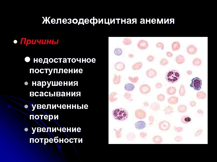 Железодефицитная анемия l Причины l недостаточное поступление l нарушения всасывания l увеличенные потери l