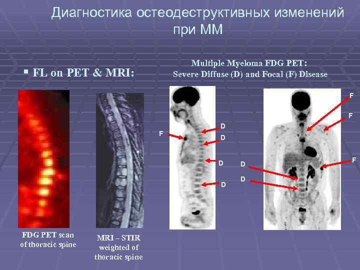 Миеломная болезнь фото больных