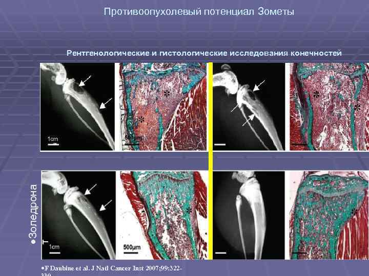 Противоопухолевый потенциал Зометы т ·Золедрона Рентгенологические и гистологические исследования конечностей ·F Daubine et al.