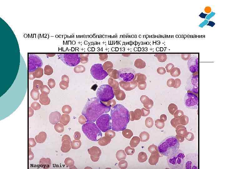 Острый миелоидный лейкоз прогноз. Острый миелобластный лейкоз. Острый миелобластный лейкоз м5а. Острый миелобластный лейкоз картина крови. Острый миелобластный лейкоз вариант м5.