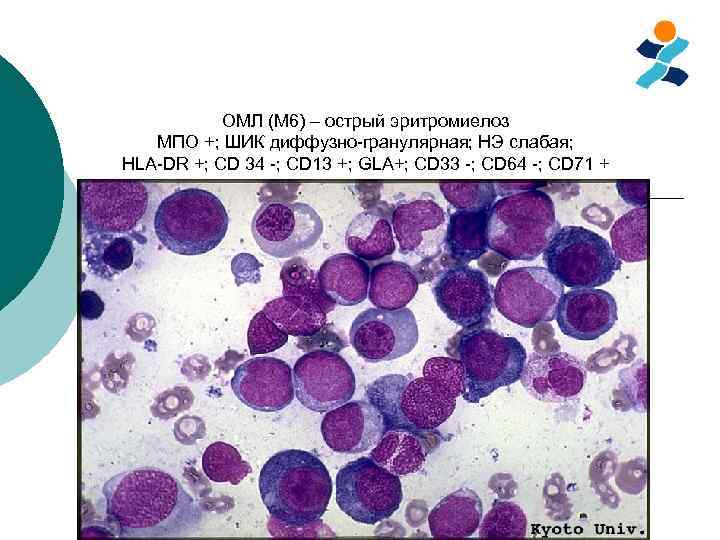 ОМЛ (M 6) – острый эритромиелоз МПО +; ШИК диффузно-гранулярная; НЭ слабая; HLA-DR +;