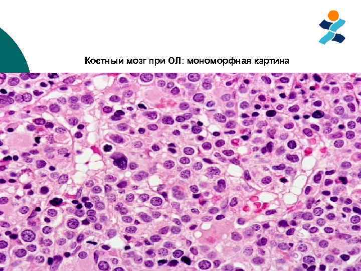 Костный мозг при ОЛ: мономорфная картина 