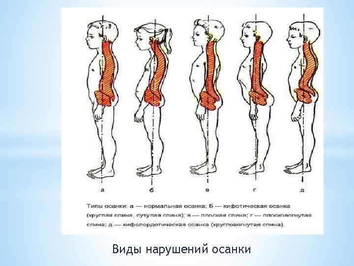 Виды нарушения осанки профилактика нарушений