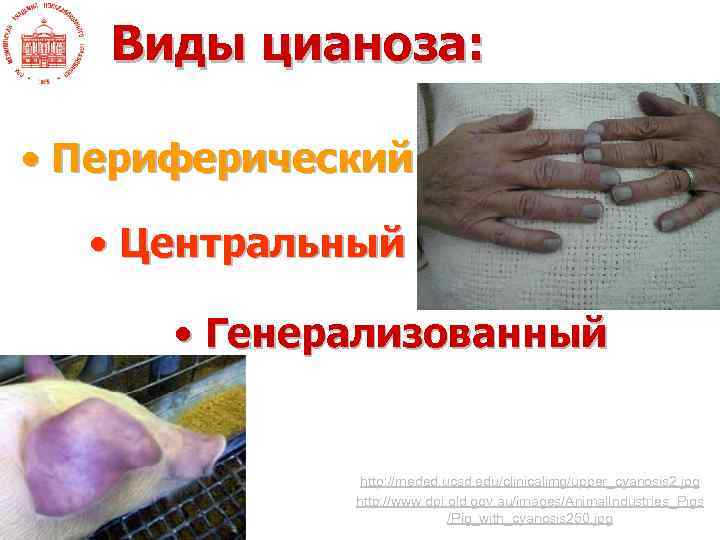 Виды цианоза: • Периферический • Центральный • Генерализованный http: //meded. ucsd. edu/clinicalimg/upper_cyanosis 2. jpg