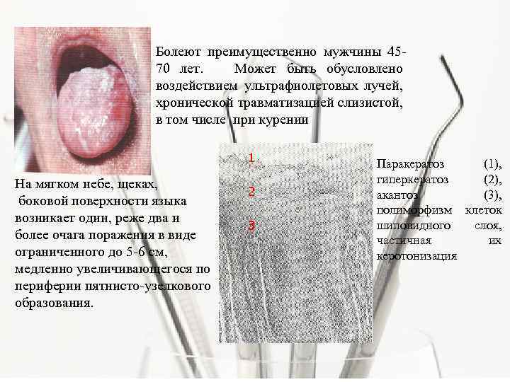 Болеют преимущественно мужчины 4570 лет. Может быть обусловлено воздействием ультрафиолетовых лучей, хронической травматизацией слизистой,