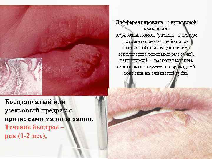 Дифференцировать : с вульгарной бородавкой. кератоакантомой (узелок, в центре которого имеется небольшое воронкообразное вдавление,
