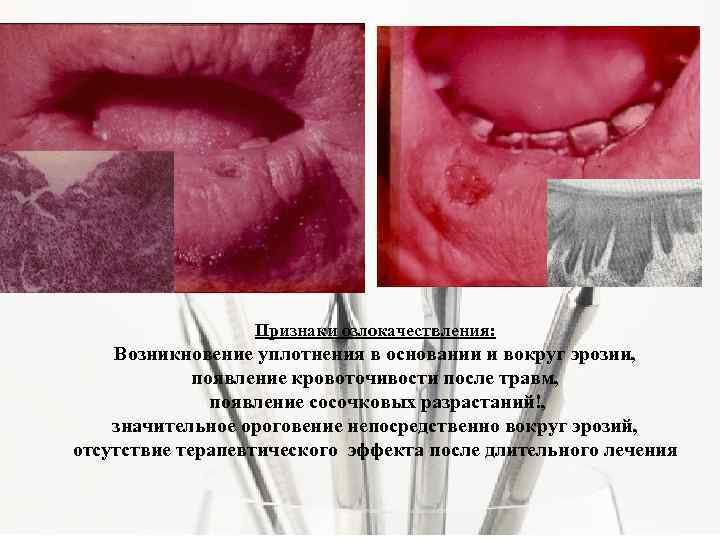 Признаки озлокачествления: Возникновение уплотнения в основании и вокруг эрозии, появление кровоточивости после травм, появление