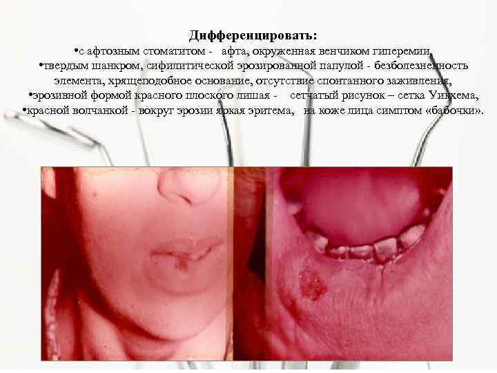 Дифференцировать: • с афтозным стоматитом - афта, окруженная венчиком гиперемии, • твердым шанкром, сифилитической