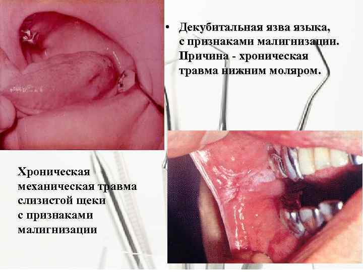  • Декубитальная язва языка, с признаками малигнизации. Причина - хроническая травма нижним моляром.