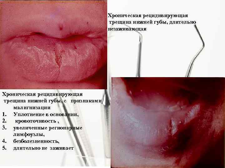 Хроническая рецидивирующая трещина нижней губы, длительно незаживающая Хроническая рецидивирующая трещина нижней губы, с признаками