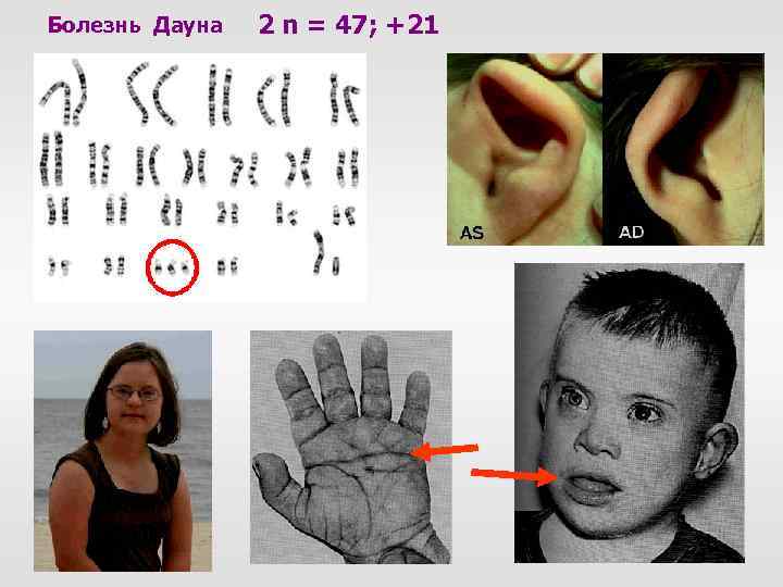 Болезнь Дауна 2 n = 47; +21 
