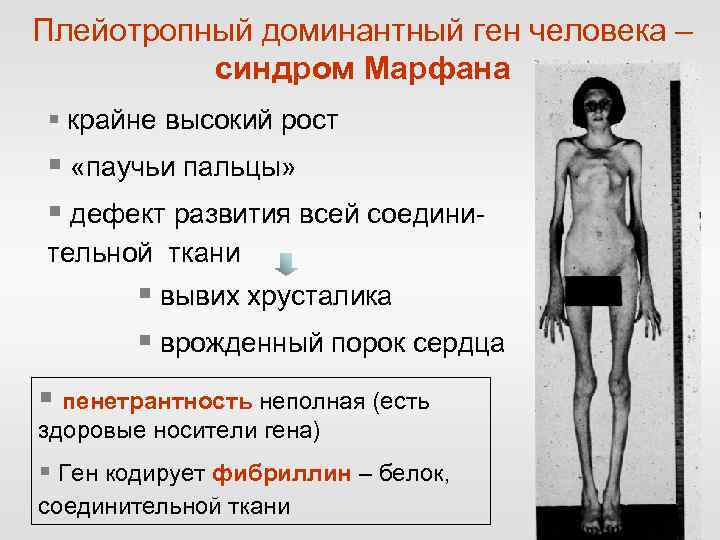 Плейотропный доминантный ген человека – синдром Марфана § крайне высокий рост § «паучьи пальцы»
