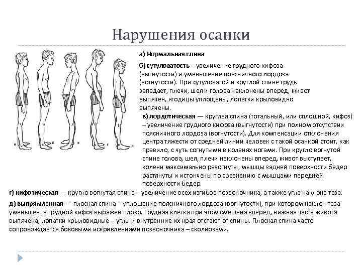 Нарушения осанки а) Нормальная спина б) сутуловатость – увеличение грудного кифоза (выгнутости) и уменьшение