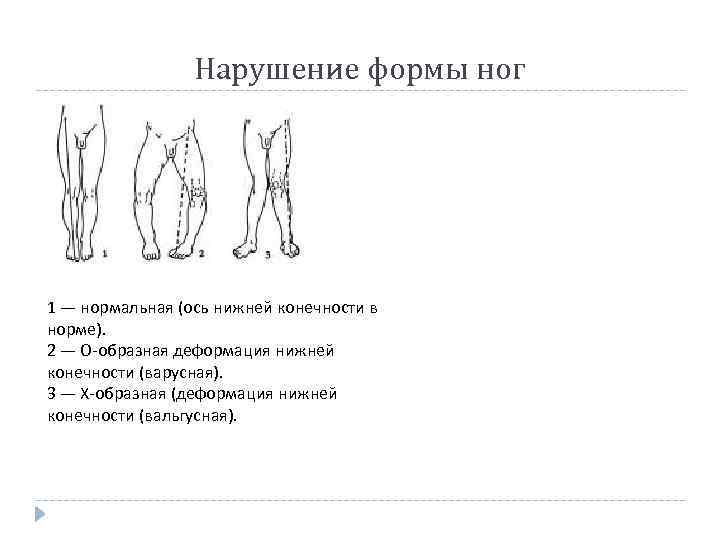 Нарушение формы ног 1 — нормальная (ось нижней конечности в норме). 2 — О-образная