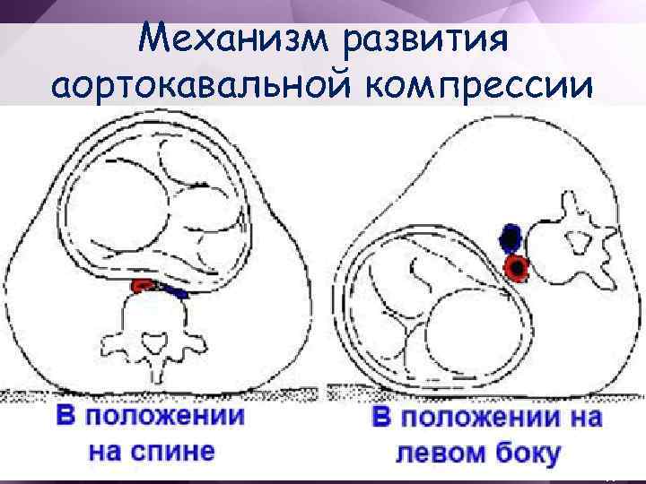 Механизм развития аортокавальной компрессии 
