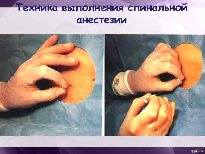 Техника выполнения спинальной анестезии 