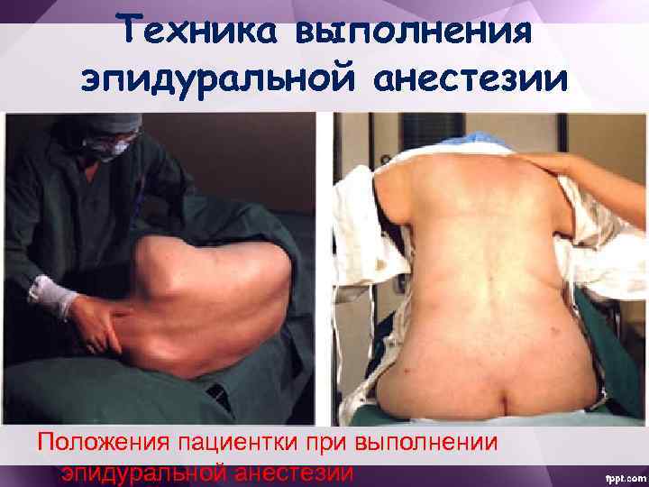 Техника выполнения эпидуральной анестезии Положения пациентки при выполнении эпидуральной анестезии 