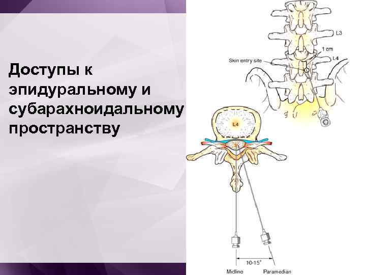  Доступы к эпидуральному и субарахноидальному пространству 