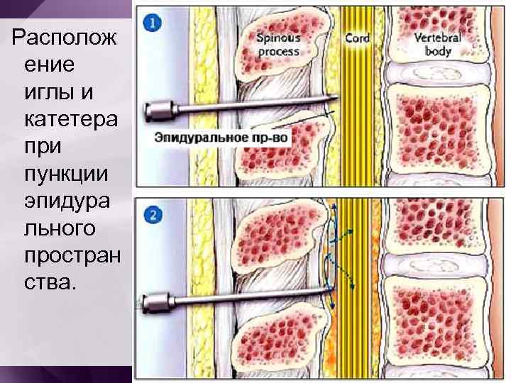  Располож ение иглы и катетера при пункции эпидура льного простран ства. 