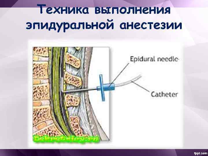 Эпидуральная анестезия это