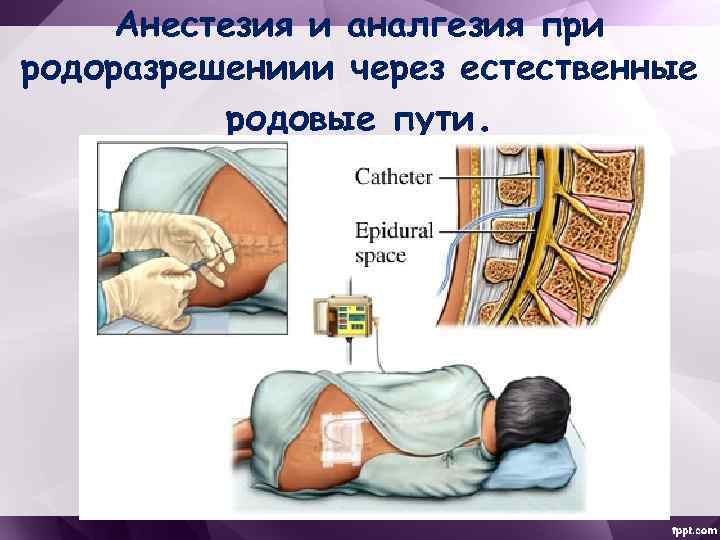 Анестезия и аналгезия при родоразрешениии через естественные родовые пути. 