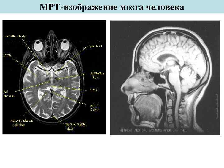 МРТ-изображение мозга человека 