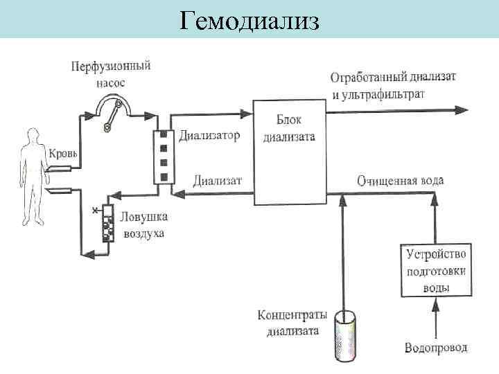 Схема искусственной почки