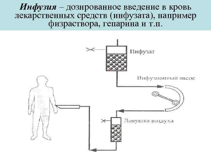 Инфузия – дозированное введение в кровь лекарственных средств (инфузата), например физраствора, гепарина и т.