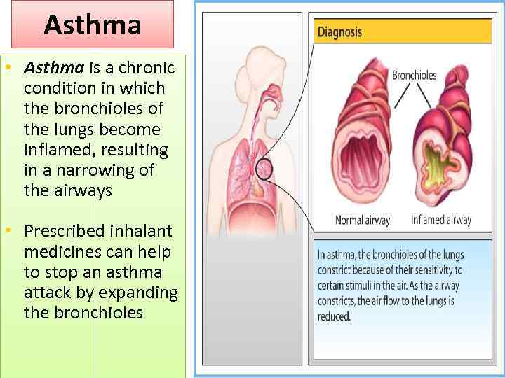 Asthma • Asthma is a chronic condition in which the bronchioles of the lungs