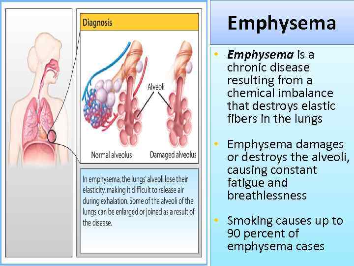 Emphysema • Emphysema is a chronic disease resulting from a chemical imbalance that destroys