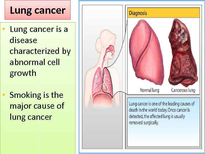 Lung cancer • Lung cancer is a disease characterized by abnormal cell growth •
