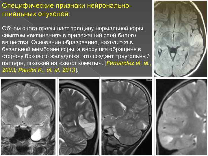 Специфические признаки нейрональноглиальных опухолей: Объем очага превышает толщину нормальной коры, симптом «вклинения» в прилежащий