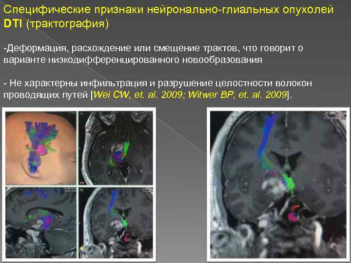 Специфические признаки нейронально-глиальных опухолей DTI (трактография) -Деформация, расхождение или смещение трактов, что говорит о