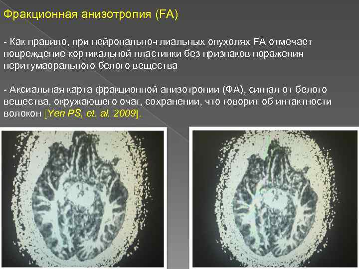 Фракционная анизотропия (FA) - Как правило, при нейронально-глиальных опухолях FA отмечает повреждение кортикальной пластинки