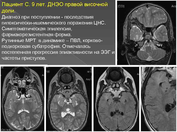 Пациент С. 9 лет. ДНЭО правой височной доли. Диагноз при поступлении - последствия гипоксически-ишемического