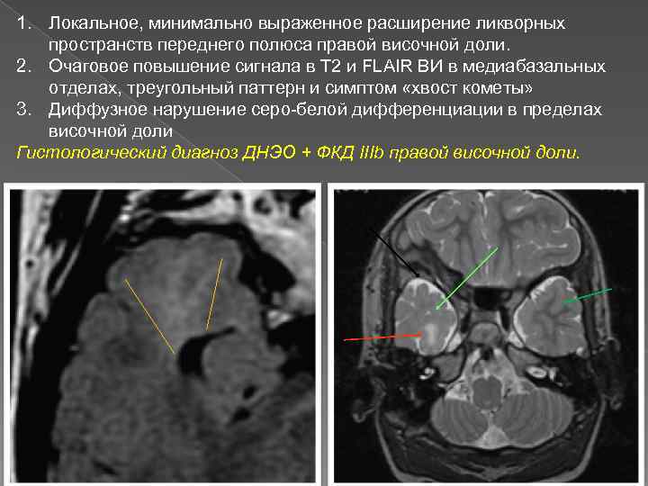 1. Локальное, минимально выраженное расширение ликворных пространств переднего полюса правой височной доли. 2. Очаговое