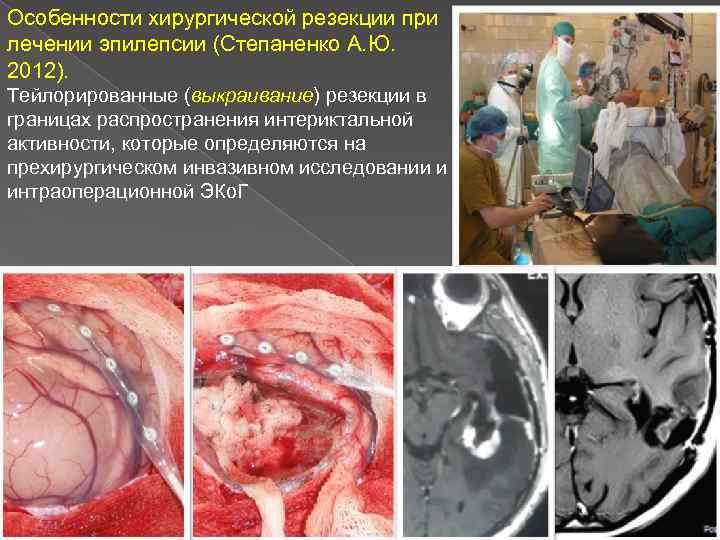 Особенности хирургической резекции при лечении эпилепсии (Степаненко А. Ю. 2012). Тейлорированные (выкраивание) резекции в