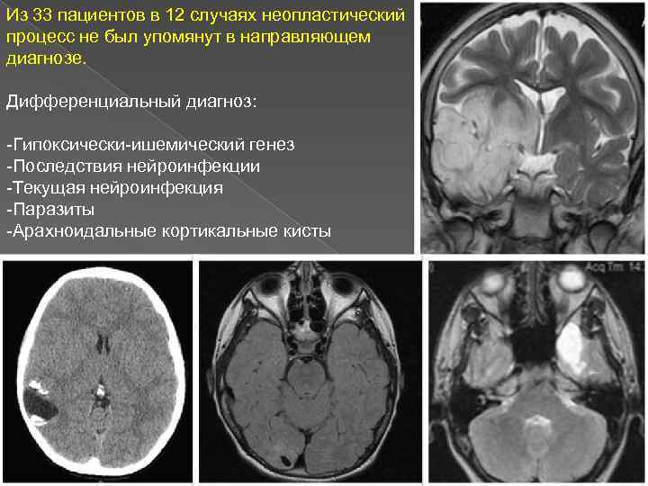 Из 33 пациентов в 12 случаях неопластический процесс не был упомянут в направляющем диагнозе.