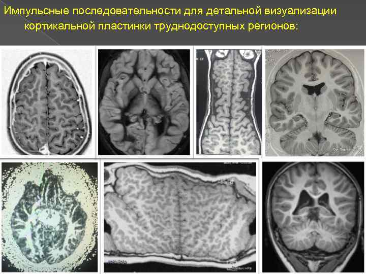 Импульсные последовательности для детальной визуализации кортикальной пластинки труднодоступных регионов: 