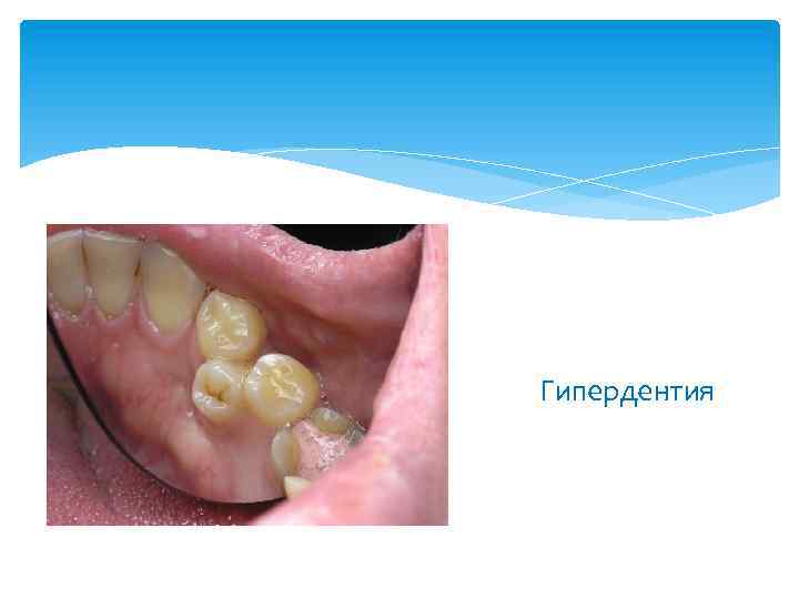 Гипердентия 