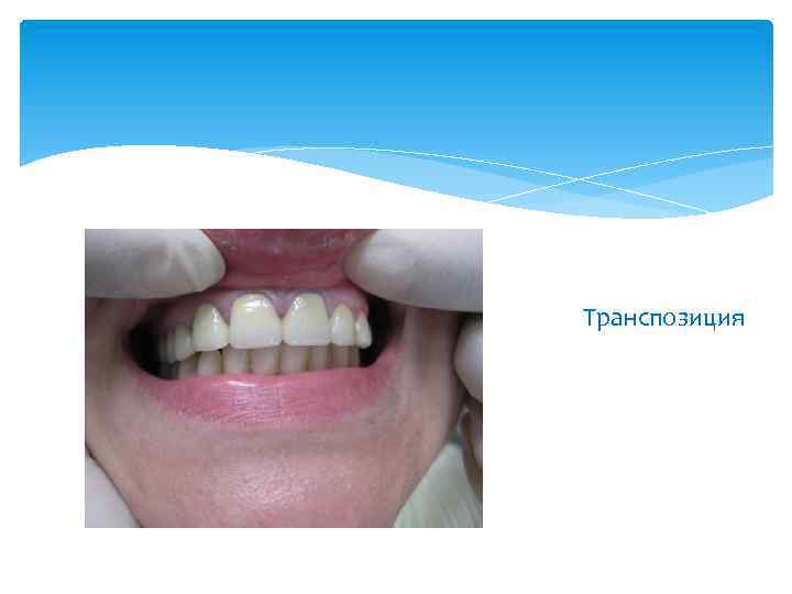 Транспозиция 