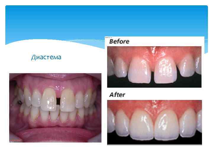 Диастема 