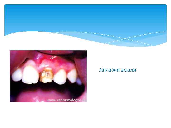 Аплазия эмали 