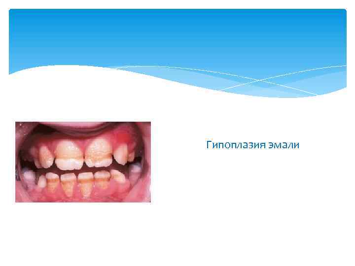 Гипоплазия эмали 