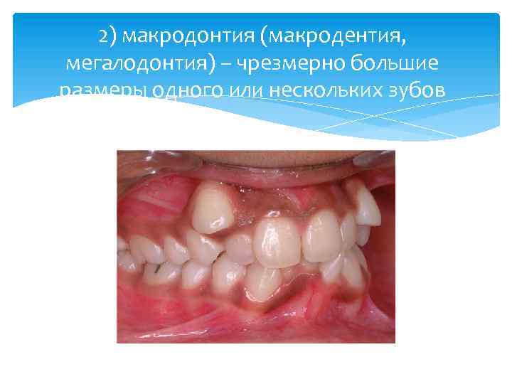 2) макродонтия (макродентия, мегалодонтия) – чрезмерно большие размеры одного или нескольких зубов 