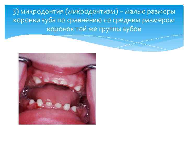 3) микродонтия (микродентизм) – малые размеры коронки зуба по сравнению со средним размером коронок