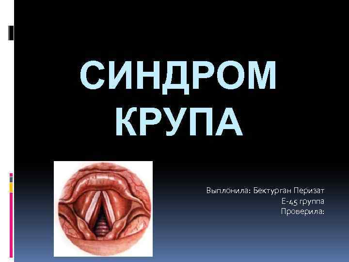 СИНДРОМ КРУПА Выплонила: Бектурган Перизат Е-45 группа Проверила: 