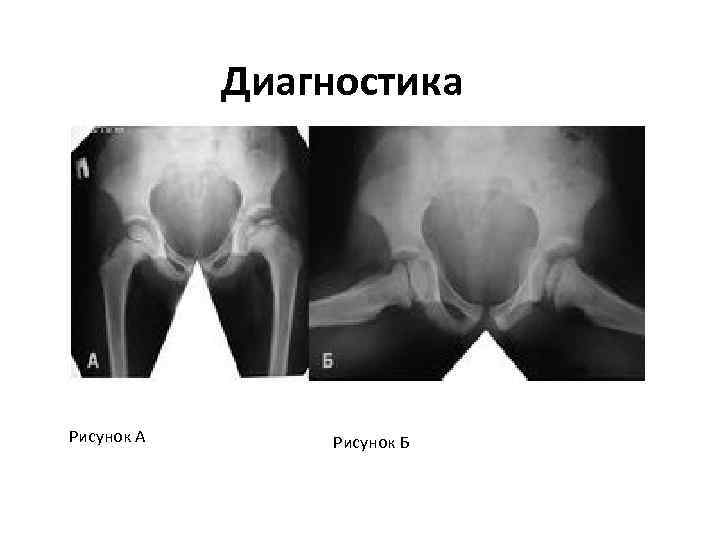 Презентация болезнь пертеса