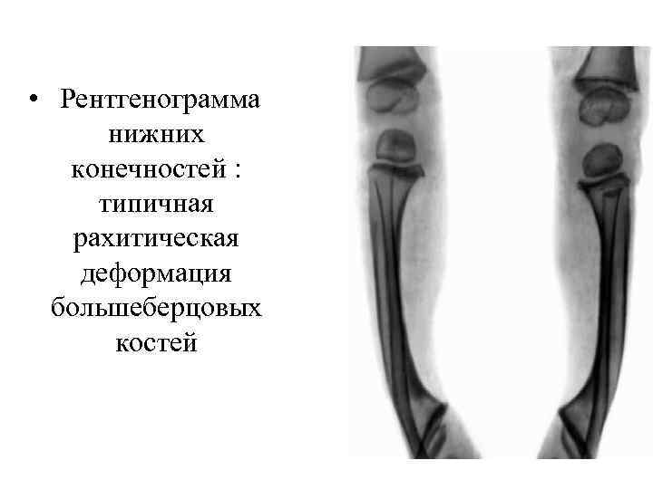  • Рентгенограмма нижних конечностей : типичная рахитическая деформация большеберцовых костей 